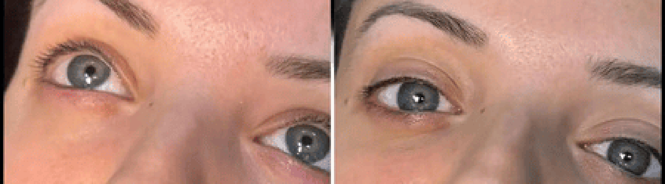 Dermal Fillers