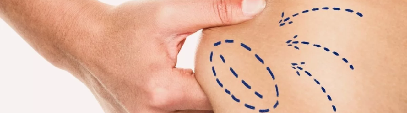 Liposuction Surgery